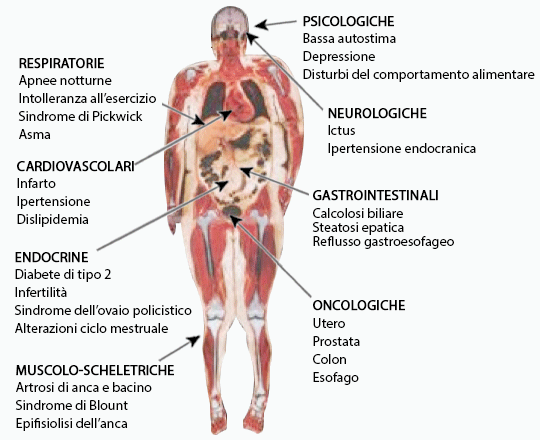 complicazioni dovute all'eccesso di grasso